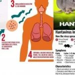 Hantavirus di Indonesia: Kenali Gejala dan Risiko yang Mengancam