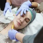 Teknologi Awet Muda Natural: Mengenal Ultherapy Prime