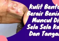 Jangan Panik: Mengenal Penyebab Kulit Bentol Berair Bening dengan Tepat