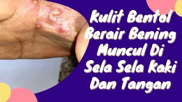 Jangan Panik: Mengenal Penyebab Kulit Bentol Berair Bening dengan Tepat