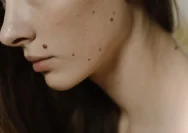 Menghilangkan Kutil dengan Cara Ampuh